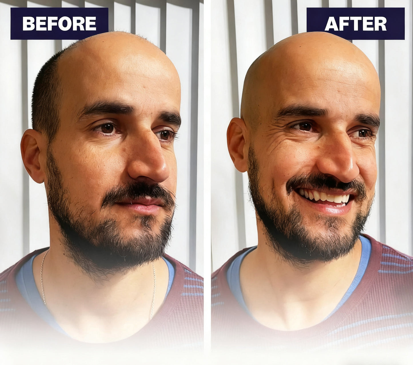 Effortless Head Shaving: Must-Have Shaver For Bald Guys