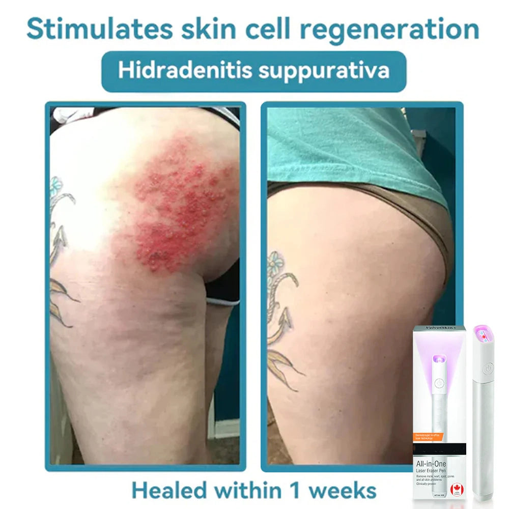 🔥2025 NEW HOT SALE-All-in-One Laser Eraser Pen🔥